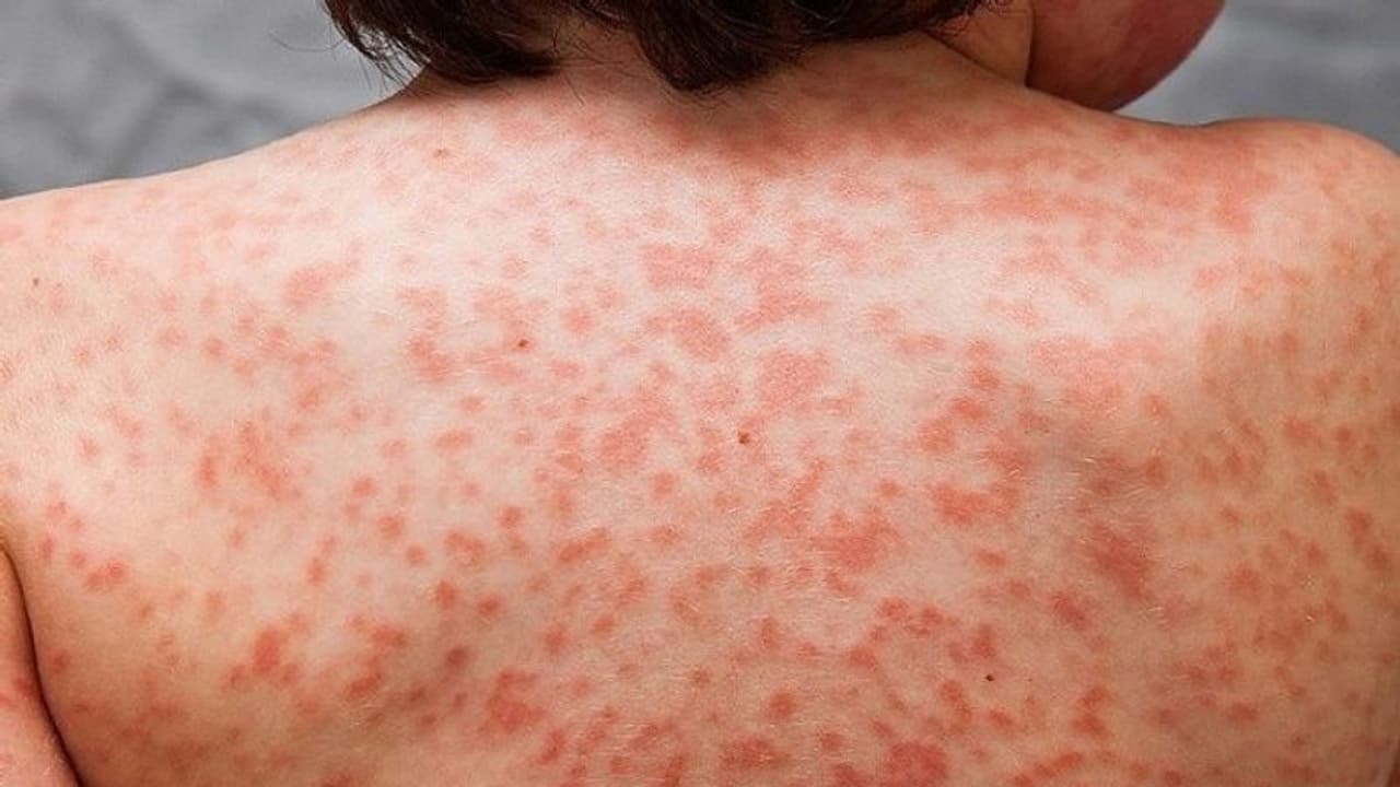 ഇത് കൊറോണയുടെ പുതിയ ലക്ഷണമോ? പരിഭ്രാന്തി പരത്തി കുട്ടികളുടെ ആരോഗ്യനില!