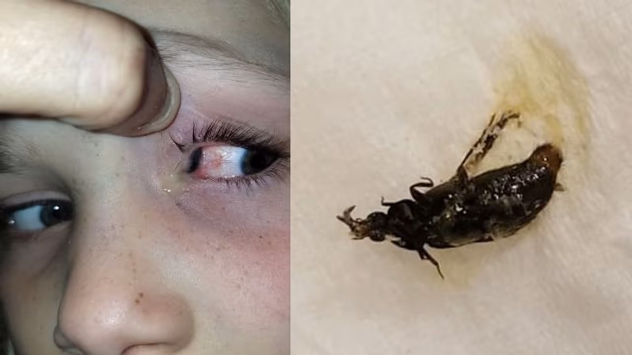 'കണ്ണ് വേദനിക്കുന്നുവെന്ന് പറഞ്ഞു, പിന്നെ മകളുടെ കണ്ണില് നിന്ന് വന്നത് ഇതാണ്...' 'കണ്ണ് വേദനിക്കുന്നുവെന്ന് പറഞ്ഞു, പിന്നെ മകളുടെ കണ്ണില് നിന്ന് വന്നത് ഇതാണ്...'