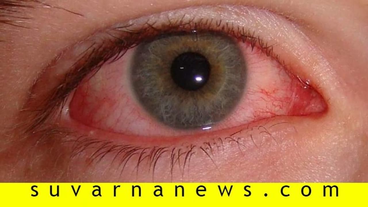 Madras Eye : வேகமெடுக்கும் மெட்ராஸ் ஐ பரவல்! தெரிந்துகொள்ள வேண்டிய தடுப்புமுறைகள்! Madras Eye : வேகமெடுக்கும் மெட்ராஸ் ஐ பரவல்! தெரிந்துகொள்ள வேண்டிய தடுப்புமுறைகள்!