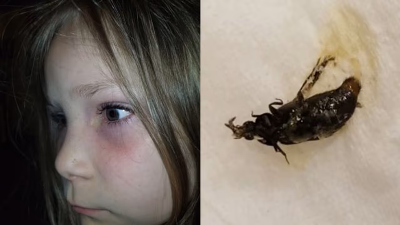 শিশুর চোখের ভিতরে আটকে জ্যান্ত গুবরে পোকা, ছবি দেখে হতবাক নেটিজেনরা শিশুর চোখের ভিতরে আটকে জ্যান্ত গুবরে পোকা, ছবি দেখে হতবাক নেটিজেনরা