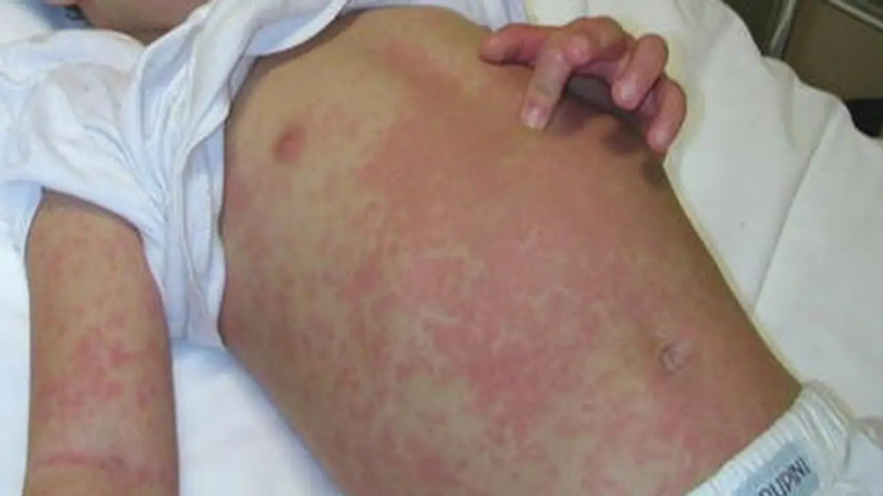 ಯಾದಗಿರಿ: ವಸತಿ ಶಾಲೆಯ 350ಕ್ಕೂ ಹೆಚ್ಚು ಮಕ್ಕಳಿಗೆ ವಿಚಿತ್ರ ಚರ್ಮರೋಗ, ಕಾರಣ ನಿಗೂಢ? ಯಾದಗಿರಿ: ವಸತಿ ಶಾಲೆಯ 350ಕ್ಕೂ ಹೆಚ್ಚು ಮಕ್ಕಳಿಗೆ ವಿಚಿತ್ರ ಚರ್ಮರೋಗ, ಕಾರಣ ನಿಗೂಢ?