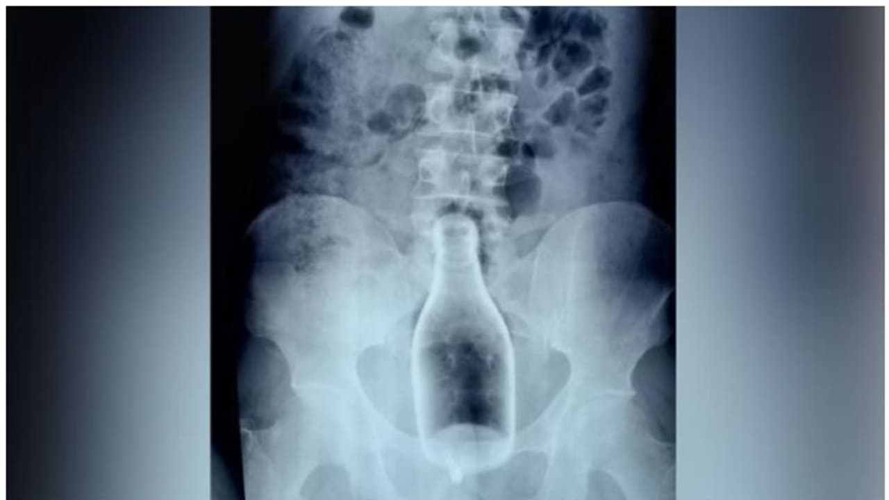 ലഹരി മൂത്ത് മദ്യക്കുപ്പി സ്വന്തം മലദ്വാരത്തില്‍ കയറ്റി യുവാവ്; പുറത്തെടുത്ത് ശസ്ത്രക്രിയയിലൂടെ