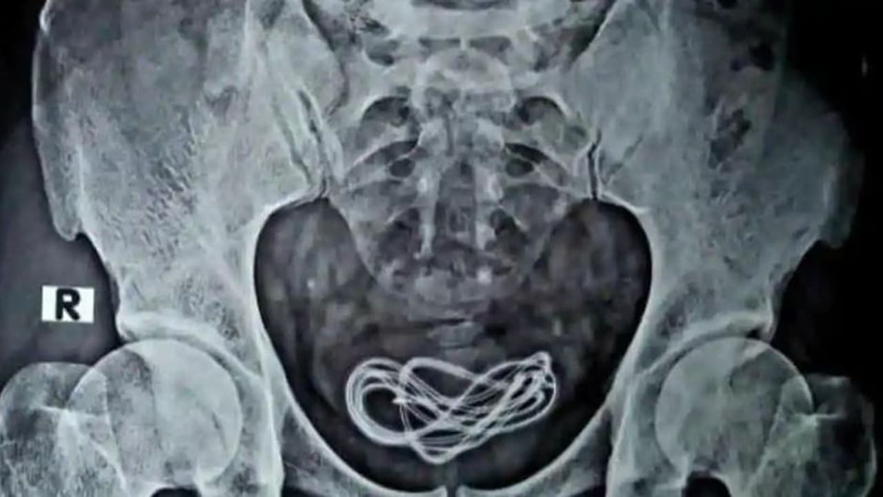 സഹിക്കാനാവാത്ത വയറുവേദന; പരിശോധനയിൽ മൂത്രസഞ്ചിയിൽ നിന്ന് കണ്ടെത്തിയത് മൊബൈൽ ഫോൺ ചാർജർ കേബിൾ സഹിക്കാനാവാത്ത വയറുവേദന; പരിശോധനയിൽ മൂത്രസഞ്ചിയിൽ നിന്ന് കണ്ടെത്തിയത് മൊബൈൽ ഫോൺ ചാർജർ കേബിൾ