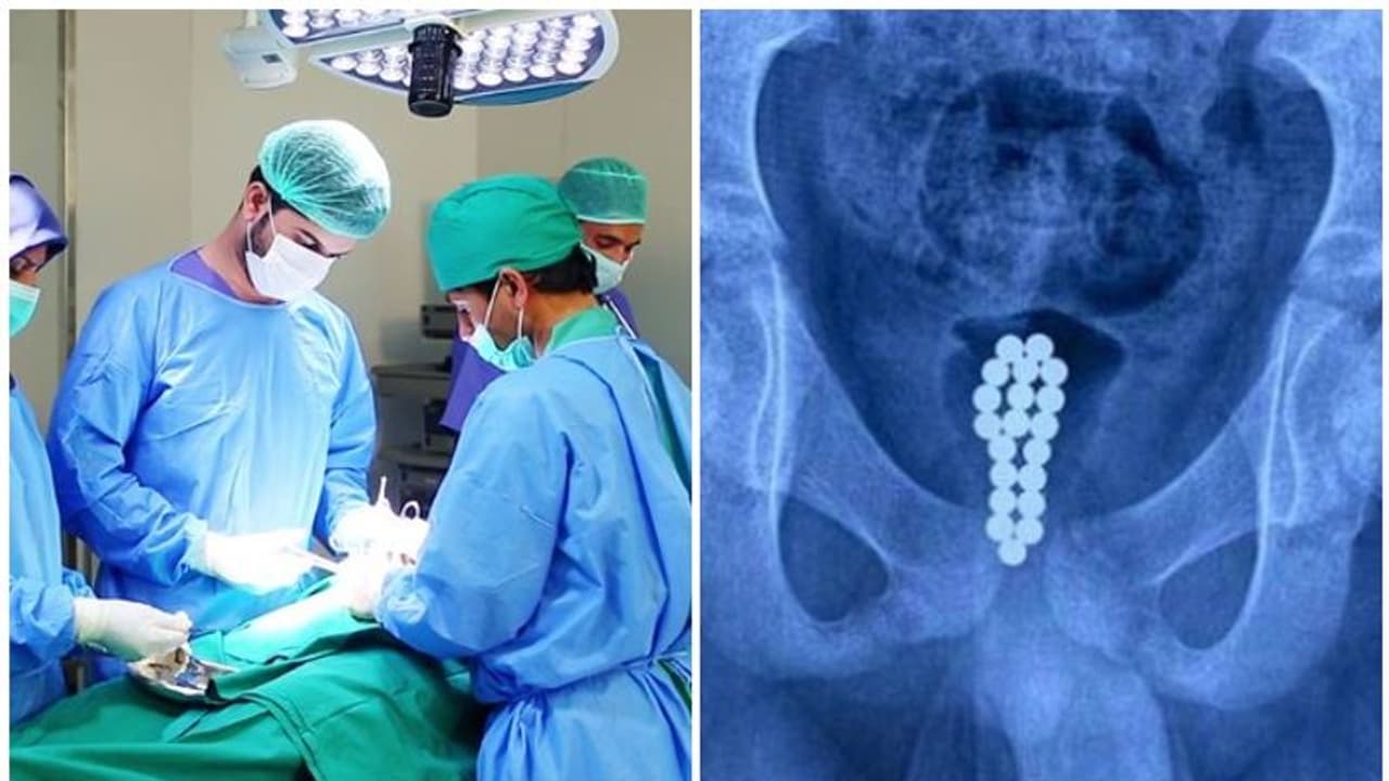 ലിംഗത്തിൽ അസഹ്യമായ വേദന; പതിനൊന്നുകാരന്റെ മൂത്രസഞ്ചിയിൽ നിന്ന് നീക്കം ചെയ്തത് 20 കാന്ത ബോളുകൾ ലിംഗത്തിൽ അസഹ്യമായ വേദന; പതിനൊന്നുകാരന്റെ മൂത്രസഞ്ചിയിൽ നിന്ന് നീക്കം ചെയ്തത് 20 കാന്ത ബോളുകൾ