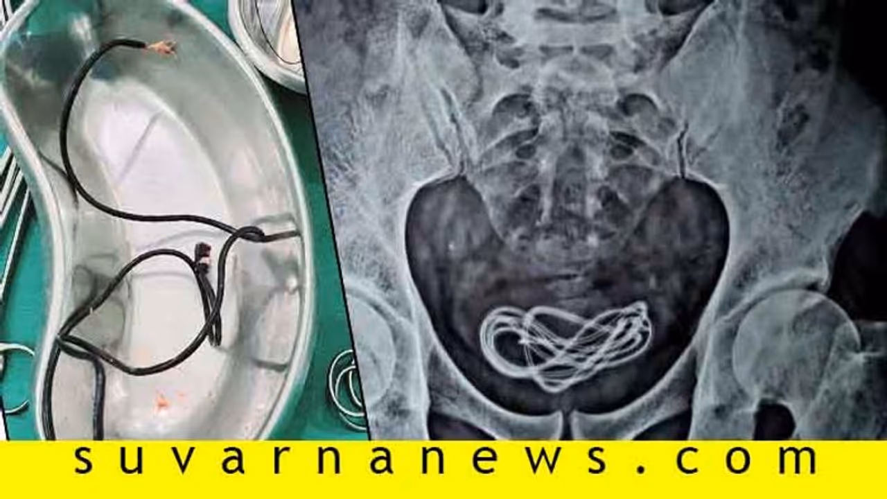 ಡಿಫರೆಂಟಾಗಿ ಹಸ್ತಮೈಥುನ ಮಾಡೋಕೆ ಹೋಗಿ ಜಾರ್ಜರ್ ಕೇಬಲ್ ಒಳಗೆ ಸೇರಿಸ್ಕೊಂಡ!