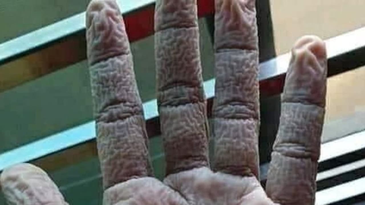 স্বাস্থ্যকর্মীর হাতের ভয়ঙ্কর ছবি ভাইরাল নেটদুনিয়ায়, প্রশ্ন মানুষের হাতও কি এমন হয় স্বাস্থ্যকর্মীর হাতের ভয়ঙ্কর ছবি ভাইরাল নেটদুনিয়ায়, প্রশ্ন মানুষের হাতও কি এমন হয়