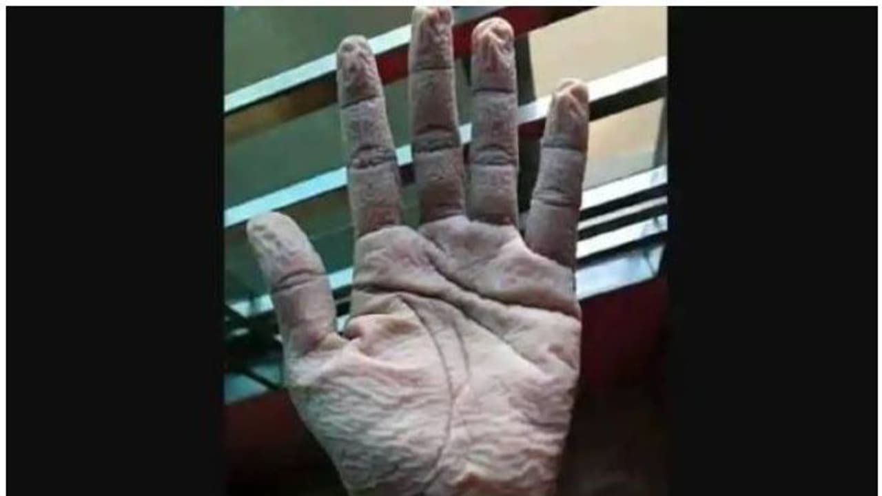 പത്ത് മണിക്കൂർ തുടർച്ചയായി ഗ്ലൗസ് ധരിച്ച ഡോക്ടറുടെ കൈ ഒടുവിൽ ഇങ്ങനെ; വെെറലായി ചിത്രം
