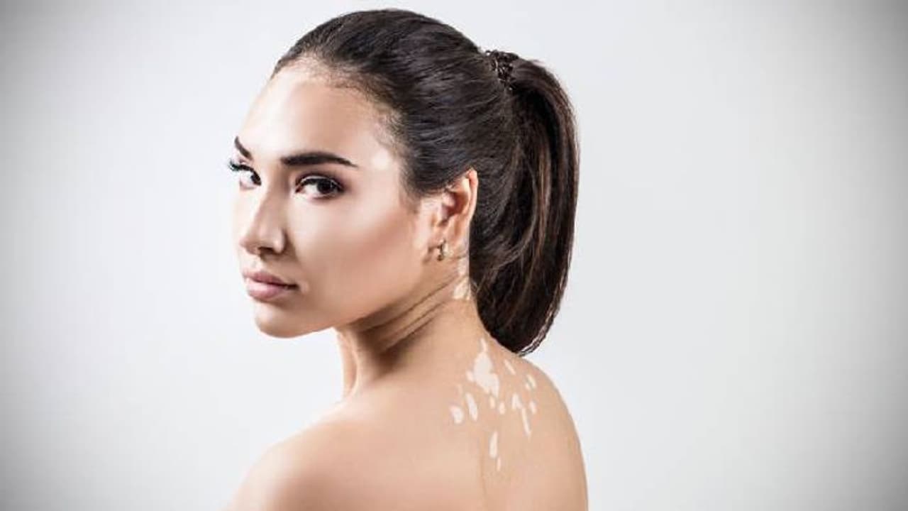 ഇന്ന് ലോക വെള്ളപ്പാണ്ട് ദിനം; അറിയാം ഈ രോഗലക്ഷണങ്ങള്... ഇന്ന് ലോക വെള്ളപ്പാണ്ട് ദിനം; അറിയാം ഈ രോഗലക്ഷണങ്ങള്...