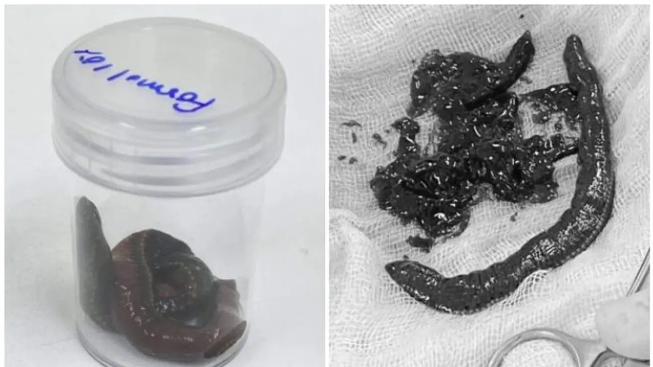 കഠിനമായ വേദനയുമായെത്തിയ വൃദ്ധന്റെ ലിംഗത്തിനുള്ളിൽ നിന്നും നീക്കം ചെയ്തത് അട്ടയെ കഠിനമായ വേദനയുമായെത്തിയ വൃദ്ധന്റെ ലിംഗത്തിനുള്ളിൽ നിന്നും നീക്കം ചെയ്തത് അട്ടയെ