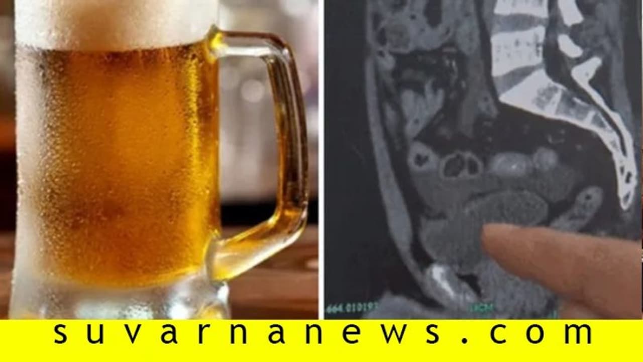 10 ಬಾಟಲ್ ಬಿಯರ್ ಕುಡಿದು, 18 ಗಂಟೆ ಮೂತ್ರ ಹಿಡಿದಿಟ್ಟಾತನ ಕಥೆ ಕೇಳಿ...! 10 ಬಾಟಲ್ ಬಿಯರ್ ಕುಡಿದು, 18 ಗಂಟೆ ಮೂತ್ರ ಹಿಡಿದಿಟ್ಟಾತನ ಕಥೆ ಕೇಳಿ...!