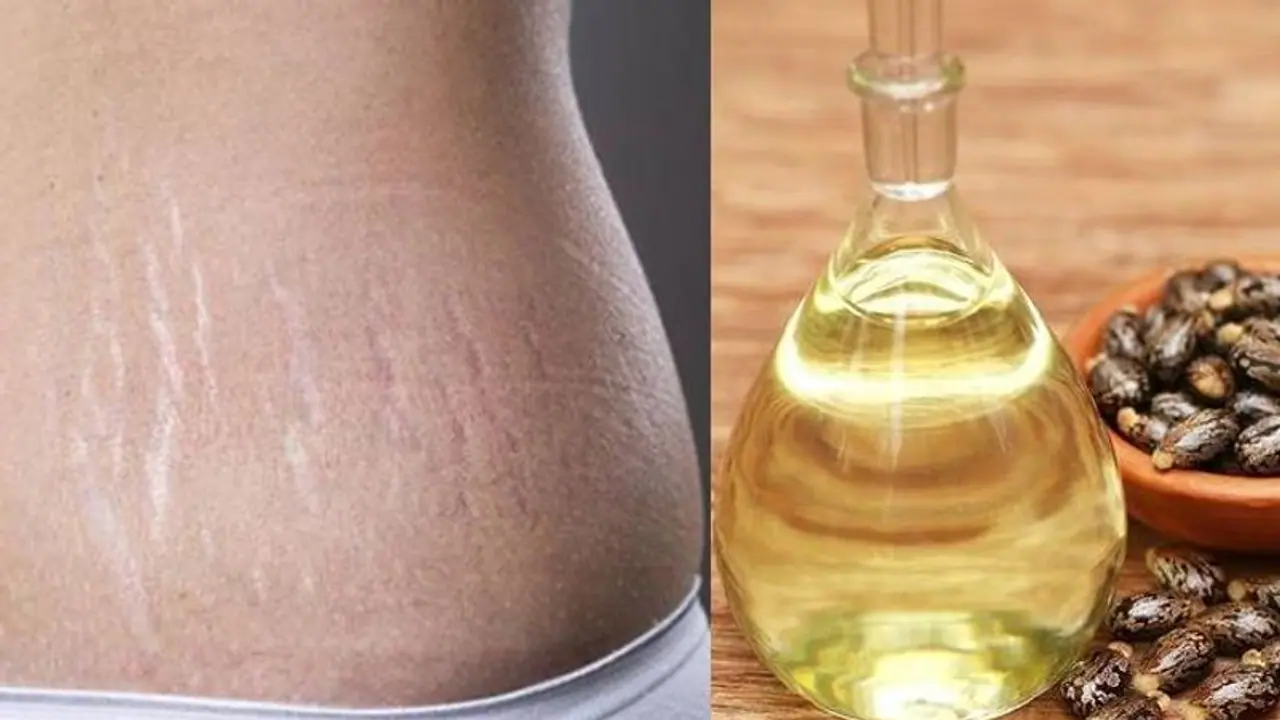 സ്ട്രെച്ച്മാർക്സ് മാറാൻ ആവണക്കെണ്ണ; അറിയാം മറ്റ് ഗുണങ്ങള്... സ്ട്രെച്ച്മാർക്സ് മാറാൻ ആവണക്കെണ്ണ; അറിയാം മറ്റ് ഗുണങ്ങള്...