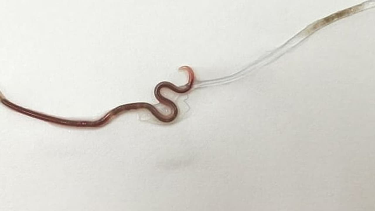 మహిళ గొంతులో వానపాము.. ఆ ఆహారం తిన్నందుకే.. మహిళ గొంతులో వానపాము.. ఆ ఆహారం తిన్నందుకే..