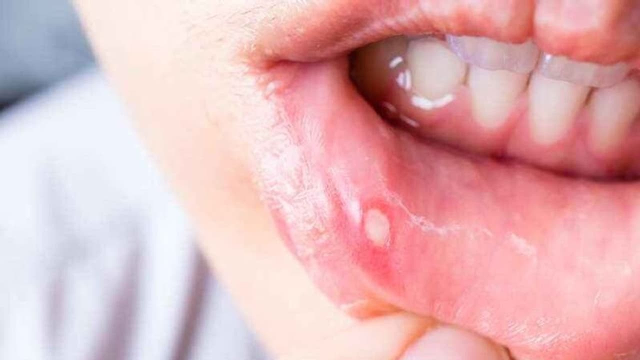 Health Tips: মুখের ভিতর ঘা বা বার বার তেষ্টা পাচ্ছে, তবে আপনারও হতে পারে এই মারাত্মক রোগ