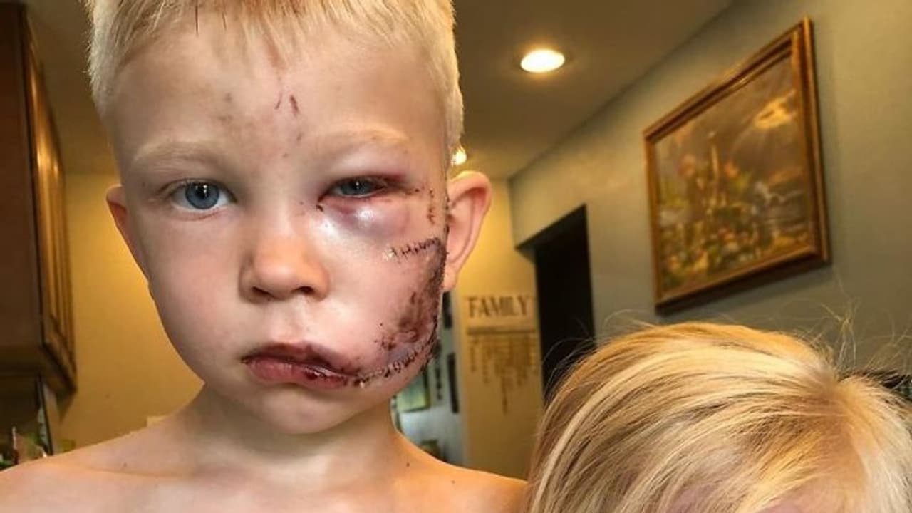 చెల్లి కోసం కుక్కతో పోరాడిన 6ఏళ్ల బుడతడు, ముఖంపై 90 కుట్లు... చెల్లి కోసం కుక్కతో పోరాడిన 6ఏళ్ల బుడతడు, ముఖంపై 90 కుట్లు...