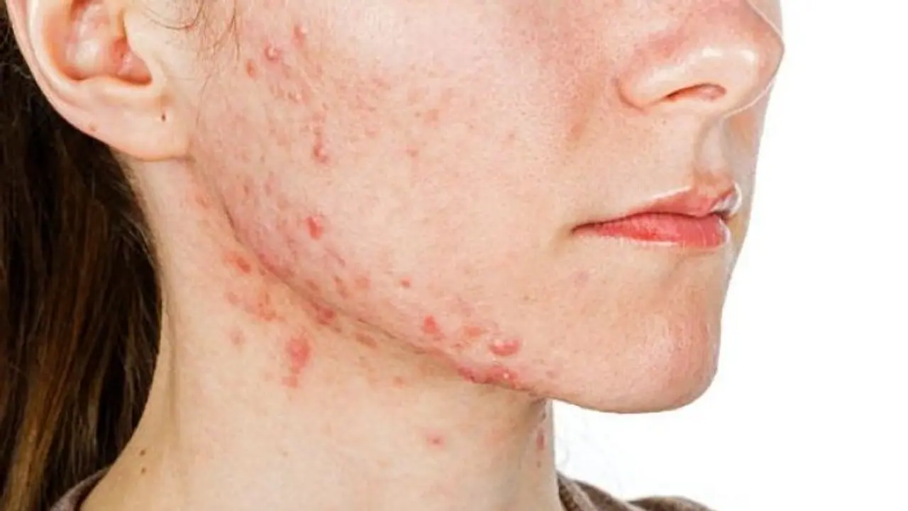 സ്ത്രീകളില്‍ അസാധാരണമായി മുഖക്കുരു വരുന്നതിനുള്ള ഒരു കാരണം...