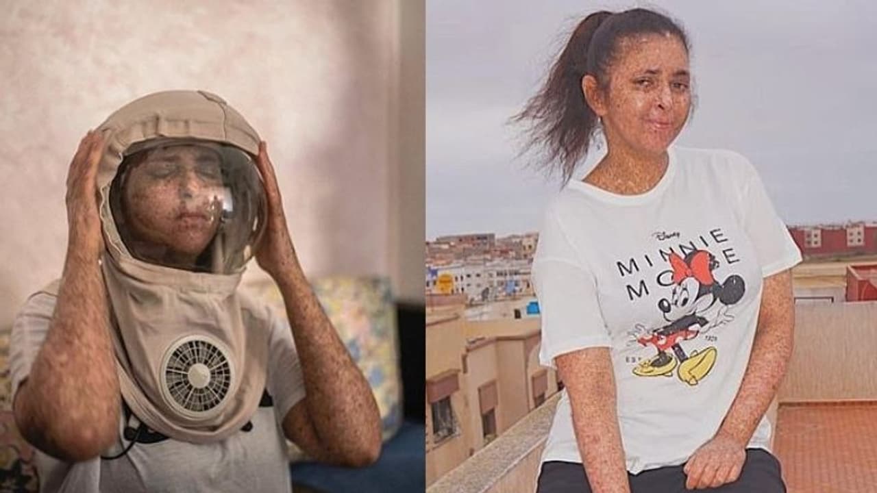 മാസ്‌ക് ധരിക്കാന്‍ മടി കാണിക്കുന്നവരൊക്കെ കാണണം, ഫാത്തിമയുടെ ജീവിതം...