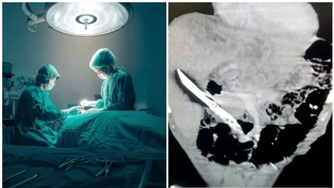 Man who swallowed knife lived with it for over a month; doctors successfully remove sharp object