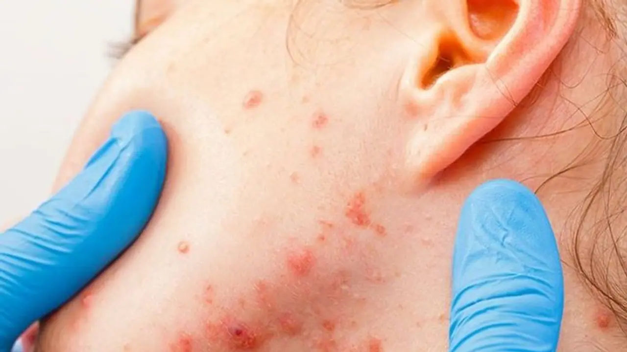 Coronavirus: Allergy care does not stop with COVID 19; here’s what you should do