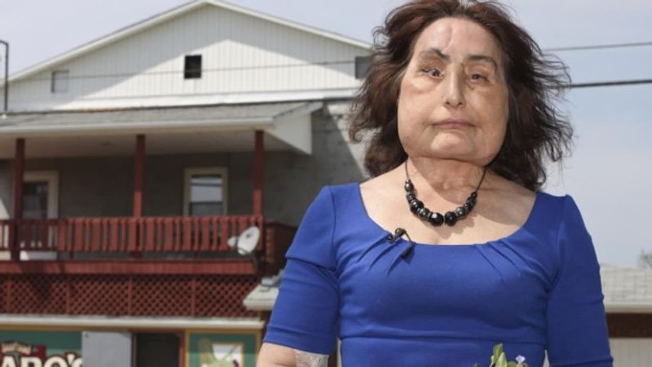 ഭര്‍ത്താവിന്റെ വെടിയേറ്റ് തകര്‍ന്ന മുഖം മാറ്റിവച്ചു; അമ്പത്തിയേഴാം വയസില്‍ മരണം