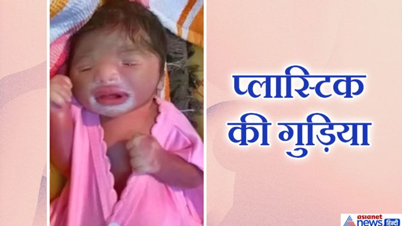 सांप की तरह केंचुली उतार रहा यह बच्चा..होंठ मछली जैसे, जब हंसता है..तो फटने लगती है स्किन सांप की तरह केंचुली उतार रहा यह बच्चा..होंठ मछली जैसे, जब हंसता है..तो फटने लगती है स्किन