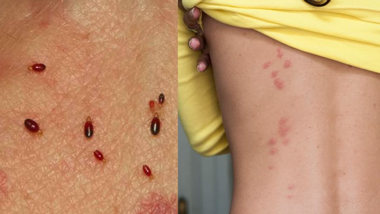 ಪ್ರಣಯ ನಗರಿಗೆ ಹೊಸ ಹಾವಳಿ : ಮೆಟ್ರೋ ಏರ್‌ಪೋರ್ಟ್‌ ಹೊಟೇಲ್‌ ಥಿಯೇಟರ್ ಎಲ್ಲೆಂದರಲ್ಲಿ ತಿಗಣೆಗಳ ದರ್ಬಾರ್‌