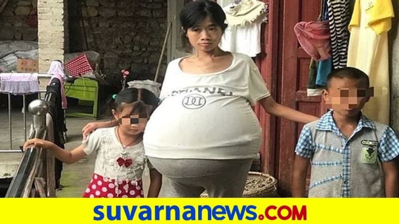 ಬೆಟ್ಟದಂತೆ ಬೆಳೆಯುತ್ತಿರುವ ಮಹಿಳೆಯ ಹೊಟ್ಟೆ; ಕಾರಣ ನಿಗೂಢ ಬೆಟ್ಟದಂತೆ ಬೆಳೆಯುತ್ತಿರುವ ಮಹಿಳೆಯ ಹೊಟ್ಟೆ; ಕಾರಣ ನಿಗೂಢ