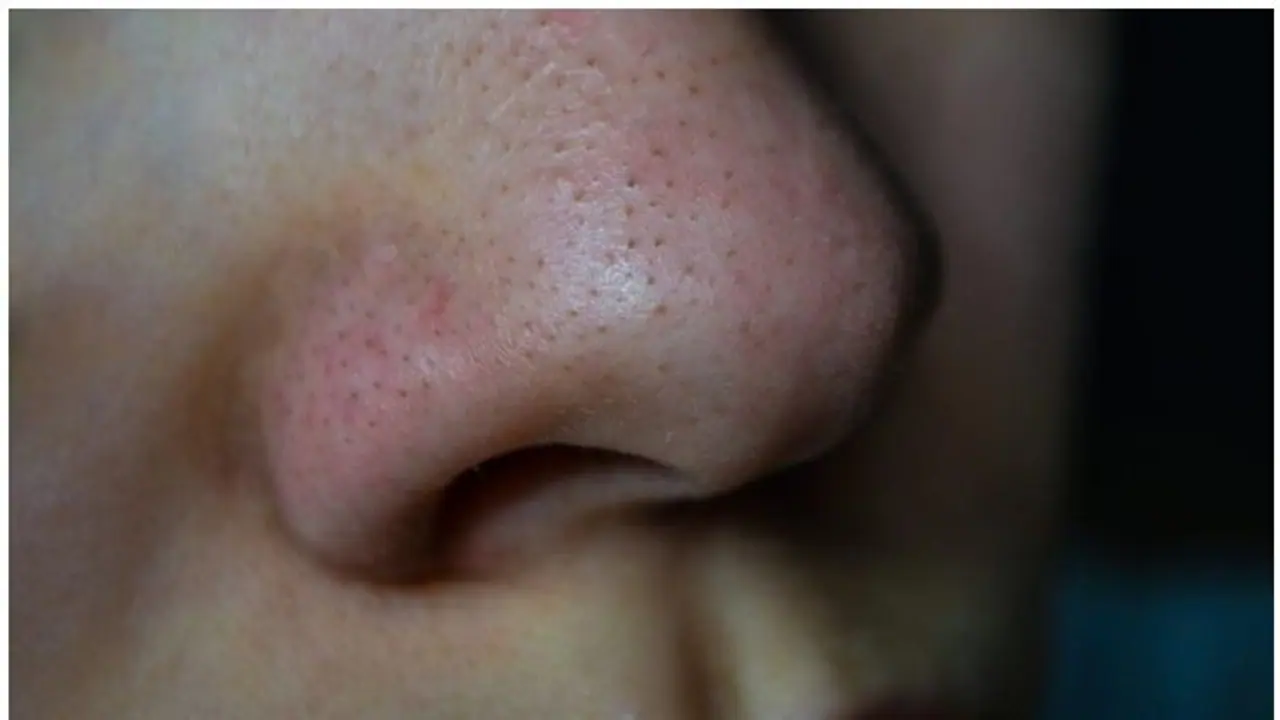 മൂക്കിന് ചുറ്റുമുള്ള 'ബ്ലാക്ക് ഹെഡ്‌സ്' എളുപ്പം അകറ്റാം; ഇതാ നാല് വഴികൾ