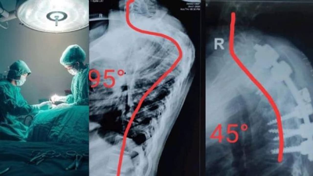 നട്ടെല്ല് 95 ഡിഗ്രി വരെ വളഞ്ഞു; പന്ത്രണ്ടുകാരിക്ക് അപൂര്വ ശസ്ത്രക്രിയ നട്ടെല്ല് 95 ഡിഗ്രി വരെ വളഞ്ഞു; പന്ത്രണ്ടുകാരിക്ക് അപൂര്വ ശസ്ത്രക്രിയ