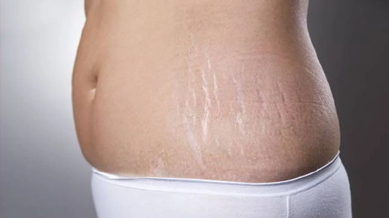 സ്‌ട്രെച്ച്‌മാർക്‌സ് മാറാൻ വീട്ടില്‍ പരീക്ഷിക്കാവുന്ന പത്ത് എളുപ്പ വഴികൾ...