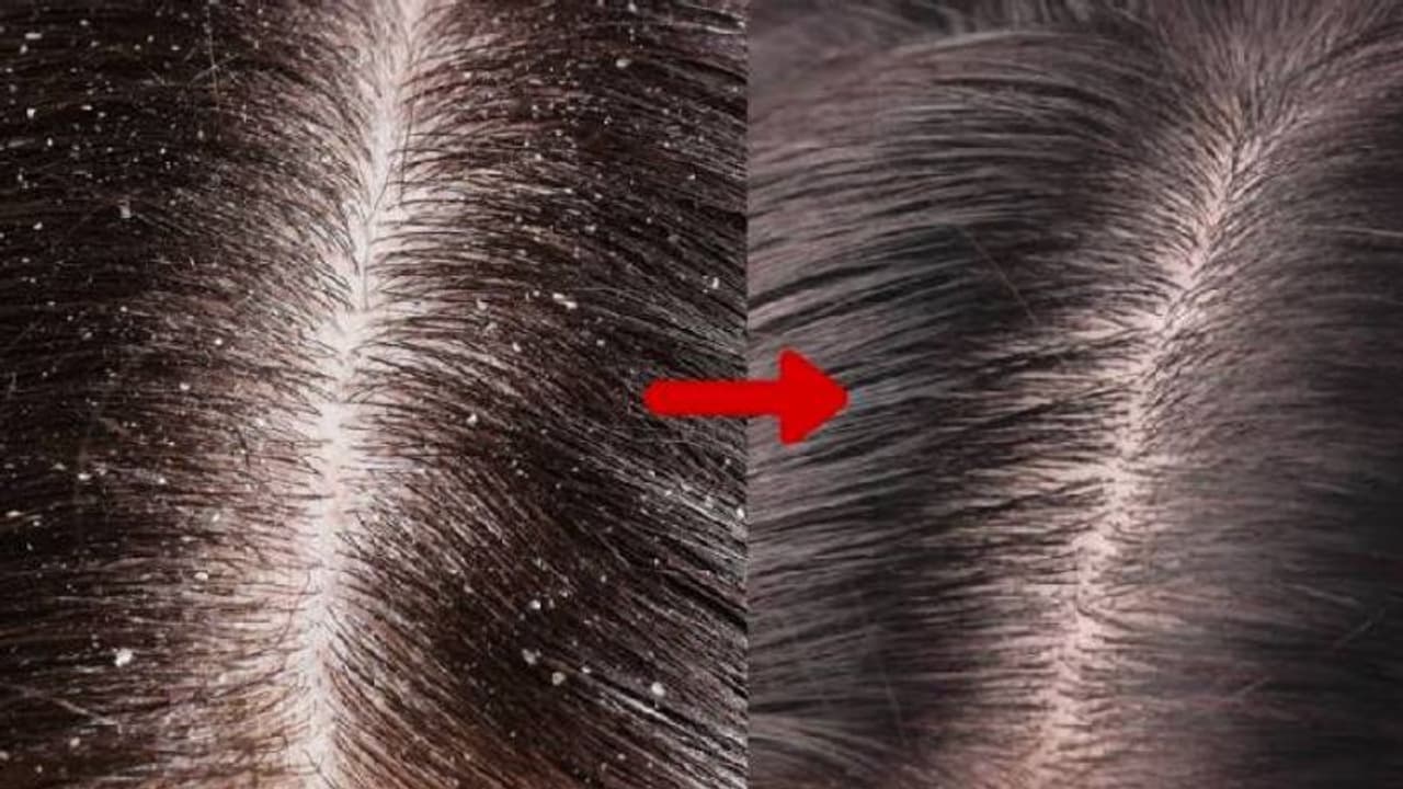 താരനോട് ഇനി 'ഗുഡ്ബൈ' പറയാം; വീട്ടില്‍ തയ്യാറാക്കാം ഈ ഹെയര്‍മാസ്ക് !