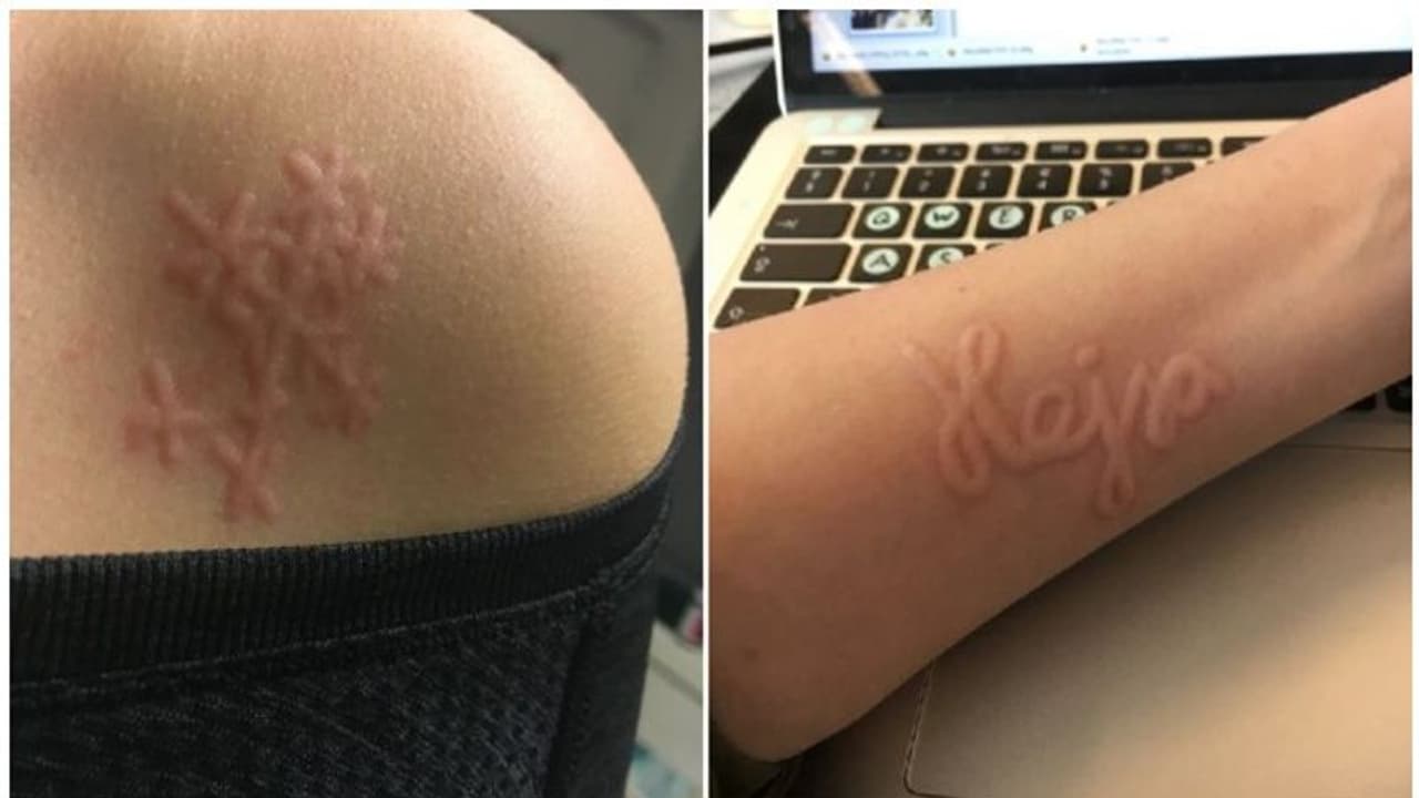 ആദ്യം തൊലി വീർക്കും, തൊടുമ്പോൾ ചുവപ്പാകും; വർഷങ്ങളായി യുവതിയെ അലട്ടുന്ന ഒരു അപൂർവ രോ​ഗാവസ്ഥ