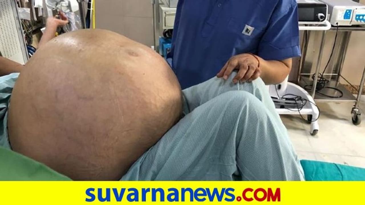 ಮಹಿಳೆಯ ದೇಹದಿಂದ 54 ಕೇಜಿ ತೂಕದ ಗಡ್ಡೆ ಹೊರಕ್ಕೆ!