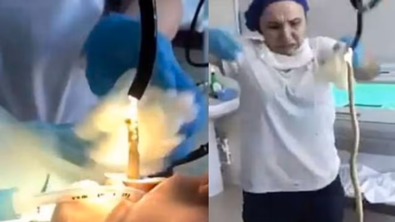 സ്ത്രീയുടെ വായിലൂടെ പുറത്തെടുത്തത് നാലടിയോളം നീളമുള്ള പാമ്പിനെ ! സ്ത്രീയുടെ വായിലൂടെ പുറത്തെടുത്തത് നാലടിയോളം നീളമുള്ള പാമ്പിനെ !