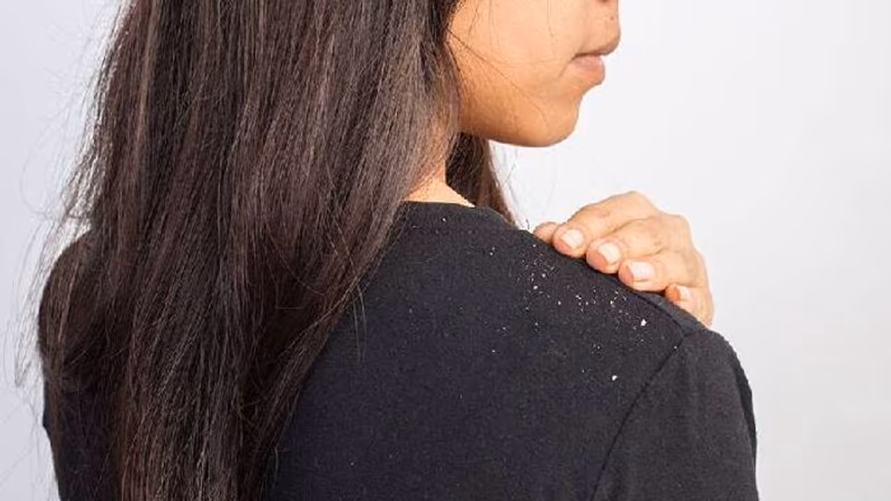 താരന് അകറ്റാന് വീട്ടില് പരീക്ഷിക്കാവുന്ന അഞ്ച് മാര്ഗങ്ങള്... താരന് അകറ്റാന് വീട്ടില് പരീക്ഷിക്കാവുന്ന അഞ്ച് മാര്ഗങ്ങള്...