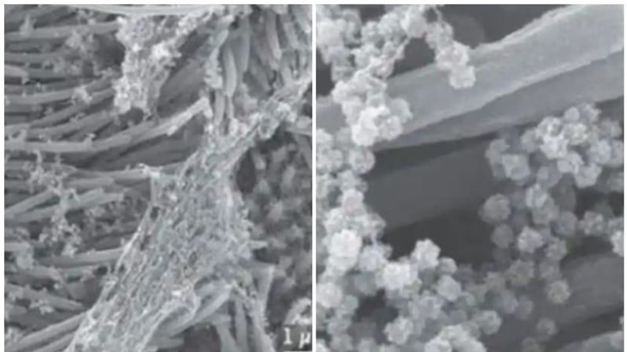 ശ്വാസകോശത്തെ ബാധിച്ച കൊറോണ വൈറസിന്റെ ചിത്രങ്ങൾ പുറത്തുവിട്ട് ​ഗവേഷകര്‍