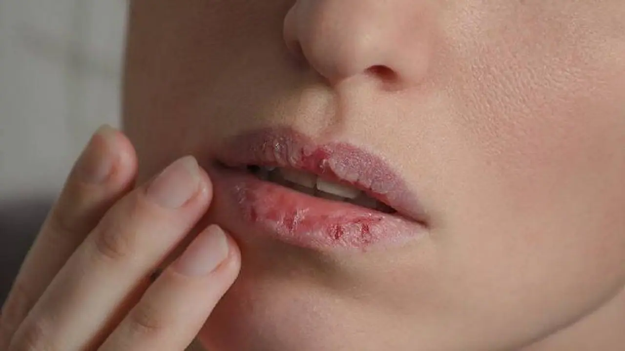 உதடு வெடிப்பு பிரச்னைக்கு தீர்வை தரும் 4 வழிகள்..!! உதடு வெடிப்பு பிரச்னைக்கு தீர்வை தரும் 4 வழிகள்..!!