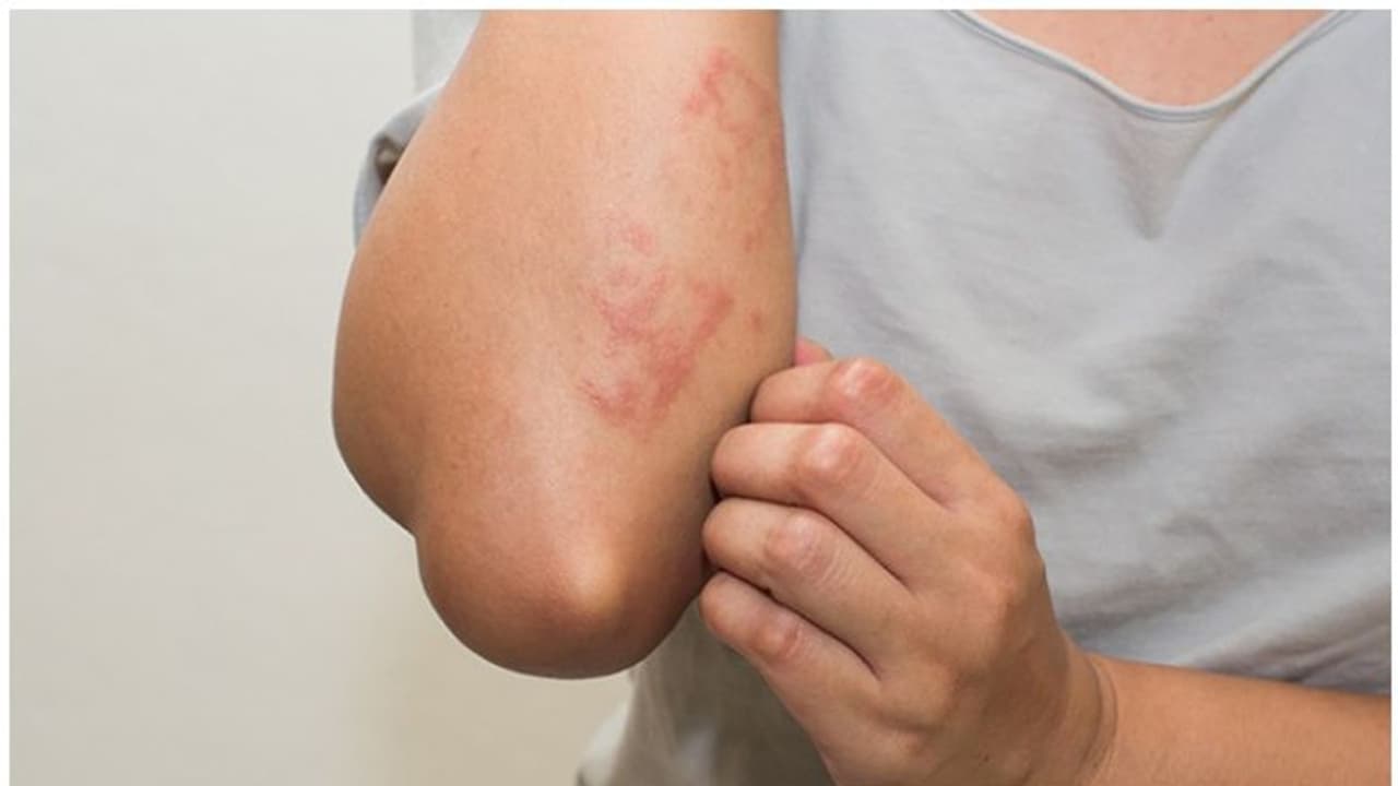 മാറാതെ നിൽക്കുന്ന ത്വക്ക് രോ​ഗങ്ങൾ, കാരണം മനസ്സിന്റെ ടെൻഷനാകാം; സൈക്കോളജിസ്റ്റ് എഴുതുന്നു