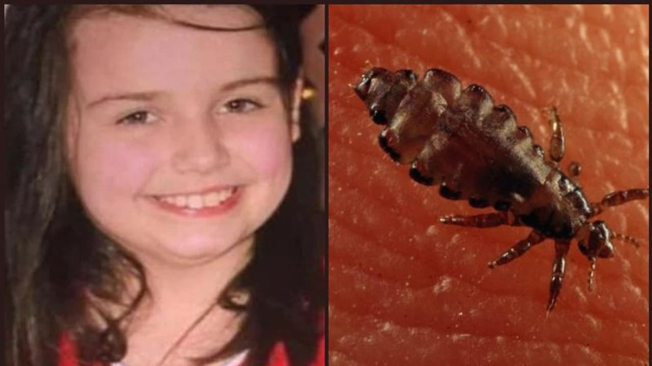 നിരന്തരം പേന് കടിയേറ്റ് പന്ത്രണ്ടുകാരി മരണപ്പെട്ടു; അച്ഛനും അമ്മയും പ്രതികള് നിരന്തരം പേന് കടിയേറ്റ് പന്ത്രണ്ടുകാരി മരണപ്പെട്ടു; അച്ഛനും അമ്മയും പ്രതികള്