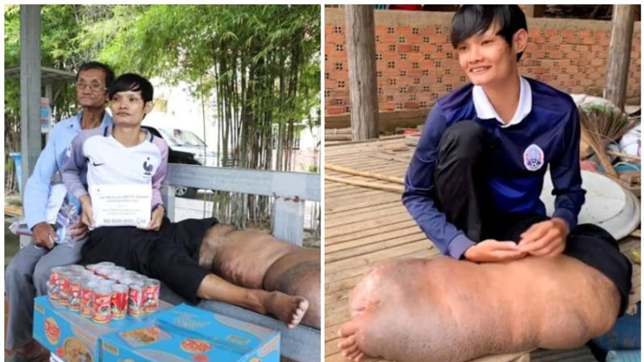 ആറാം വയസ്സിലേറ്റ ഒരൊറ്റ കൊതുകുകടിയിൽ, കാൽ തെങ്ങുപോലെ ചീർത്തുപോയ ഒരാൾ