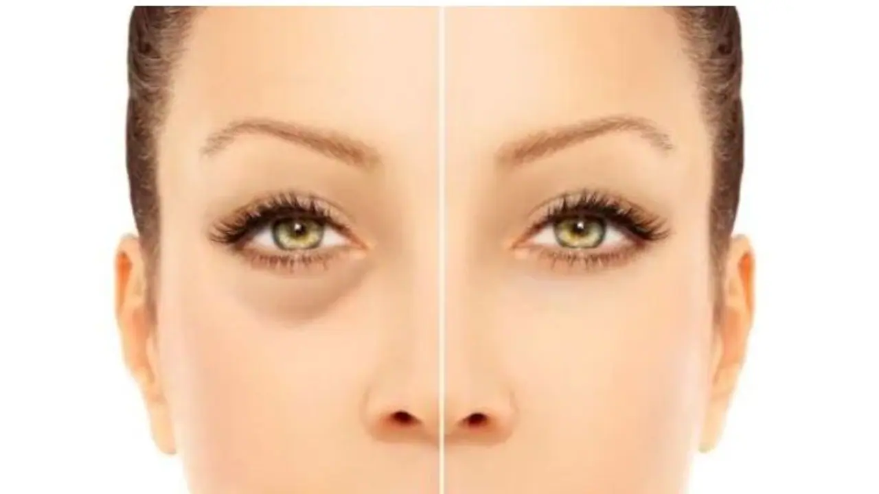 Dark Circles Treatment: বর্ষবরণের পার্টিতে যাওয়ার আগে দূর করুন ডার্ক সার্কেল, ঘরোয়া টোটকাতেই হবে কেল্লাফতে Dark Circles Treatment: বর্ষবরণের পার্টিতে যাওয়ার আগে দূর করুন ডার্ক সার্কেল, ঘরোয়া টোটকাতেই হবে কেল্লাফতে