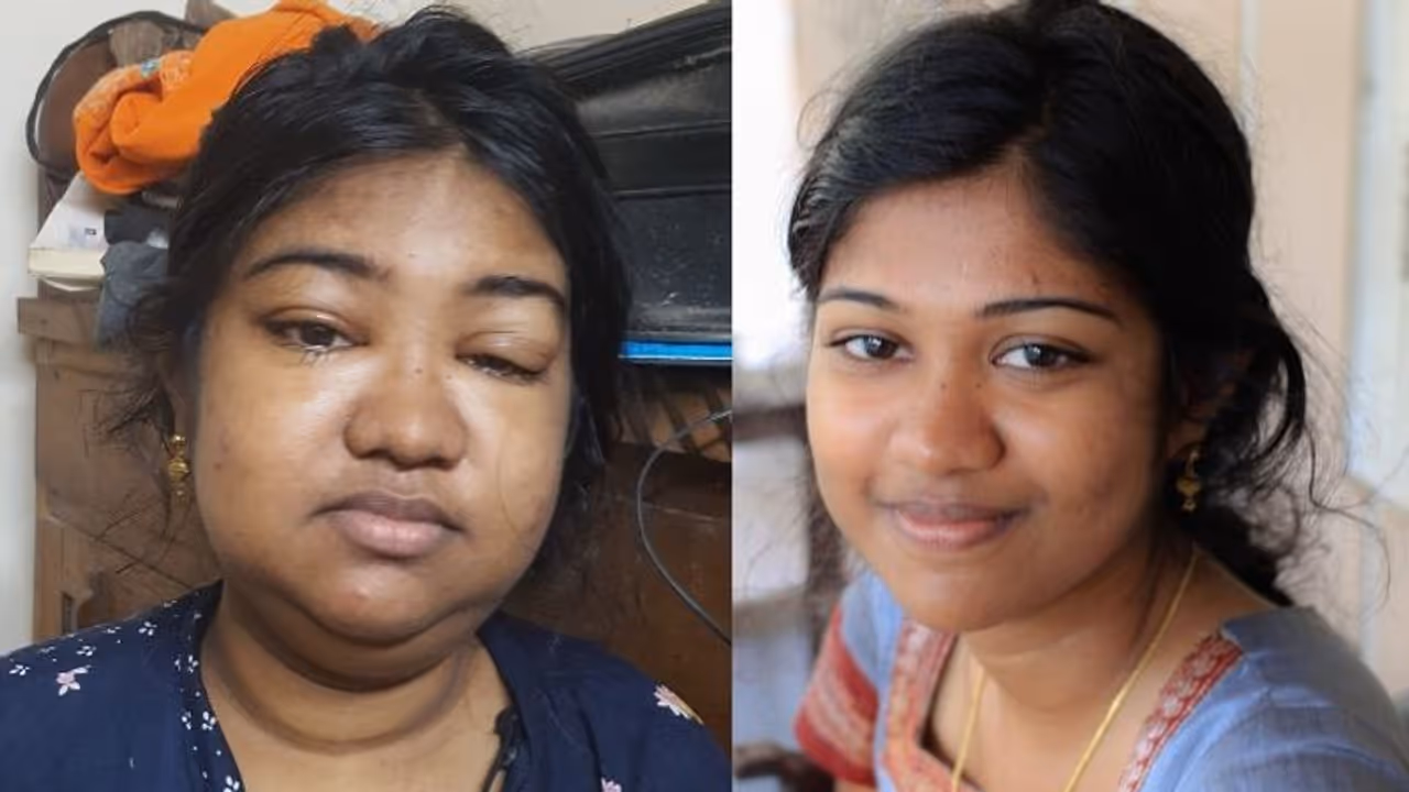 ഷിന്റുവിന് വൃക്ക അമ്മ നല്കും; ശസ്ത്രക്രിയയ്ക്ക് പക്ഷേ പണമില്ല... ഷിന്റുവിന് വൃക്ക അമ്മ നല്കും; ശസ്ത്രക്രിയയ്ക്ക് പക്ഷേ പണമില്ല...