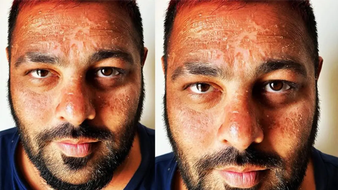 रैपर बादशाह का इसलिए हुआ बुरा हाल, चेहरे पर पड़े लाल धब्बे, छिल गई स्किन, देखकर शॉक्ड हुए दोस्त रैपर बादशाह का इसलिए हुआ बुरा हाल, चेहरे पर पड़े लाल धब्बे, छिल गई स्किन, देखकर शॉक्ड हुए दोस्त