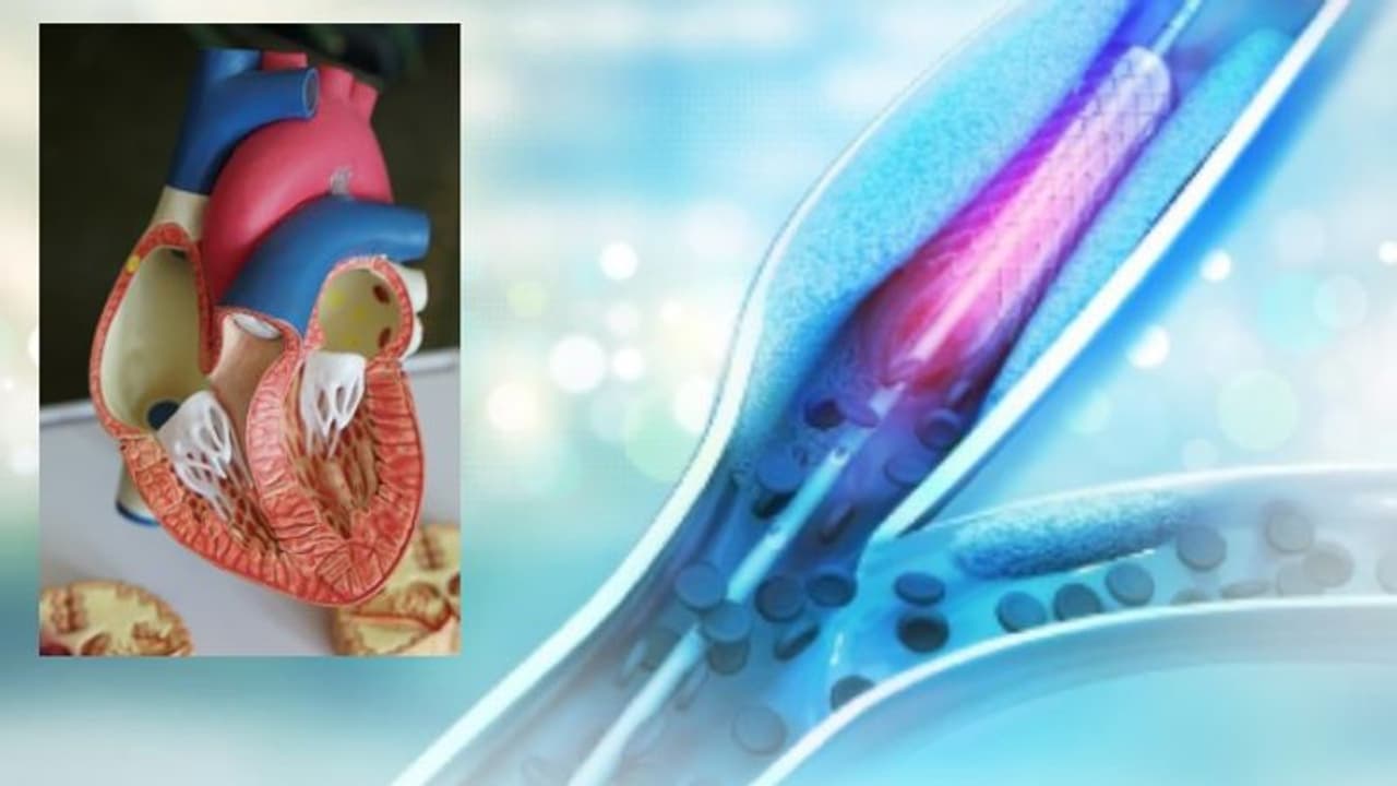 হার্ট অ্যাটাকের পরে করা হয় কপিল দেব এর করোনারি অ্যাঞ্জিওপ্লাস্টি, জেনে নিন এটি কি এবং কিভাবে করা হয় হার্ট অ্যাটাকের পরে করা হয় কপিল দেব এর করোনারি অ্যাঞ্জিওপ্লাস্টি, জেনে নিন এটি কি এবং কিভাবে করা হয়