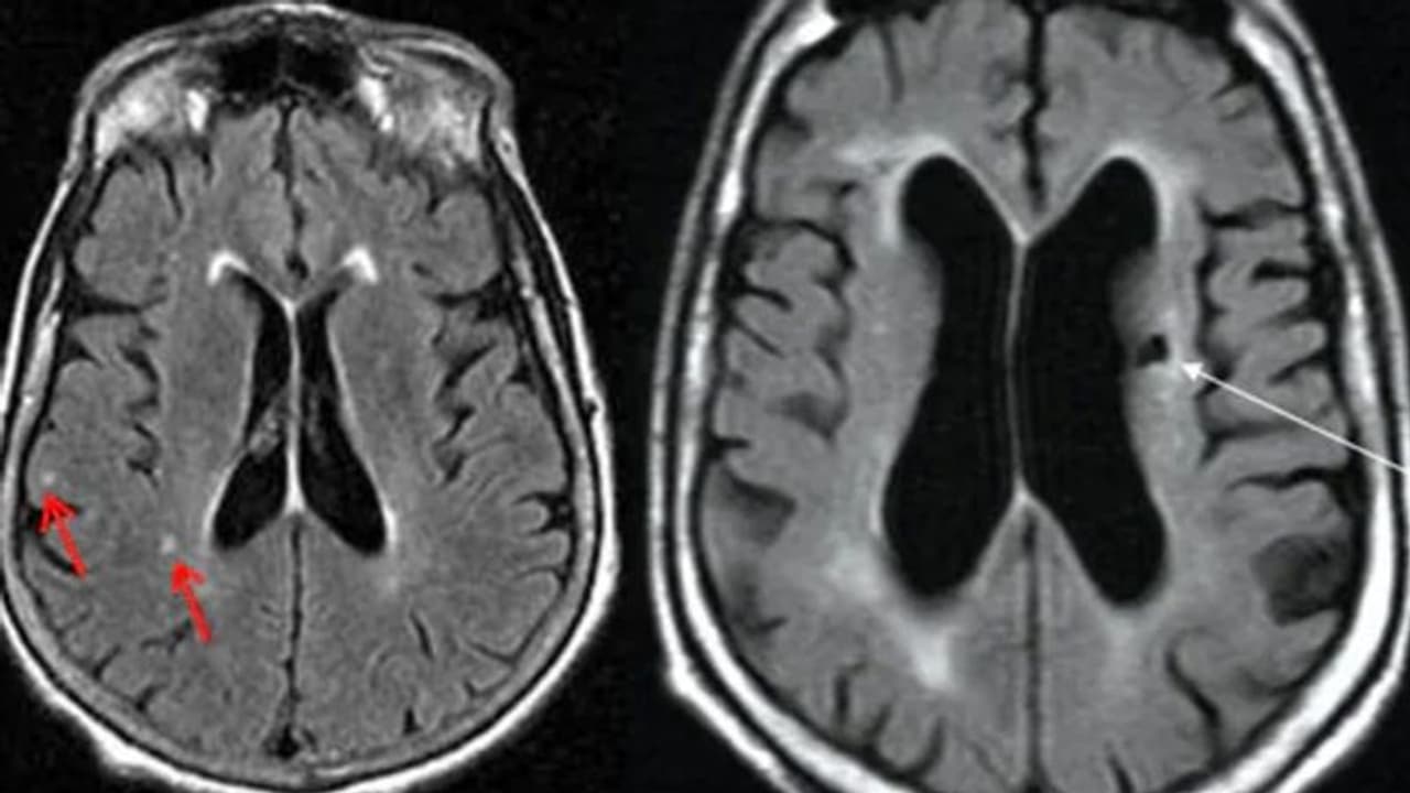 'സൈലന്റ് സ്‌ട്രോക്ക്'; തിരിച്ചറിയാം ലക്ഷണങ്ങളിലൂടെ...