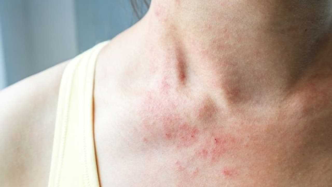 'തൊലിപ്പുറത്ത് വരുന്ന ചുവന്ന തടിപ്പും പാടുകളും കൊവിഡ് ലക്ഷണമാകാം...'