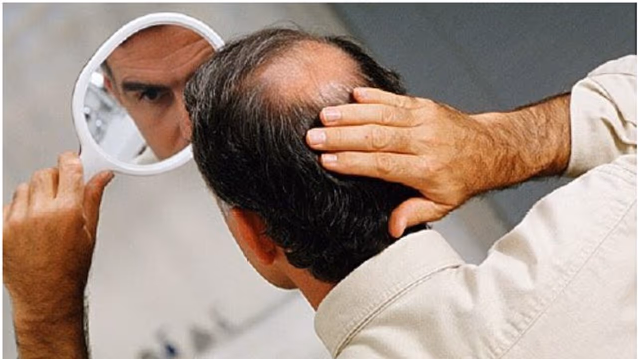 പുരുഷന്മാരിൽ കഷണ്ടി ഉണ്ടാകുന്നതിന് പിന്നിലെ നാല് കാരണങ്ങൾ 