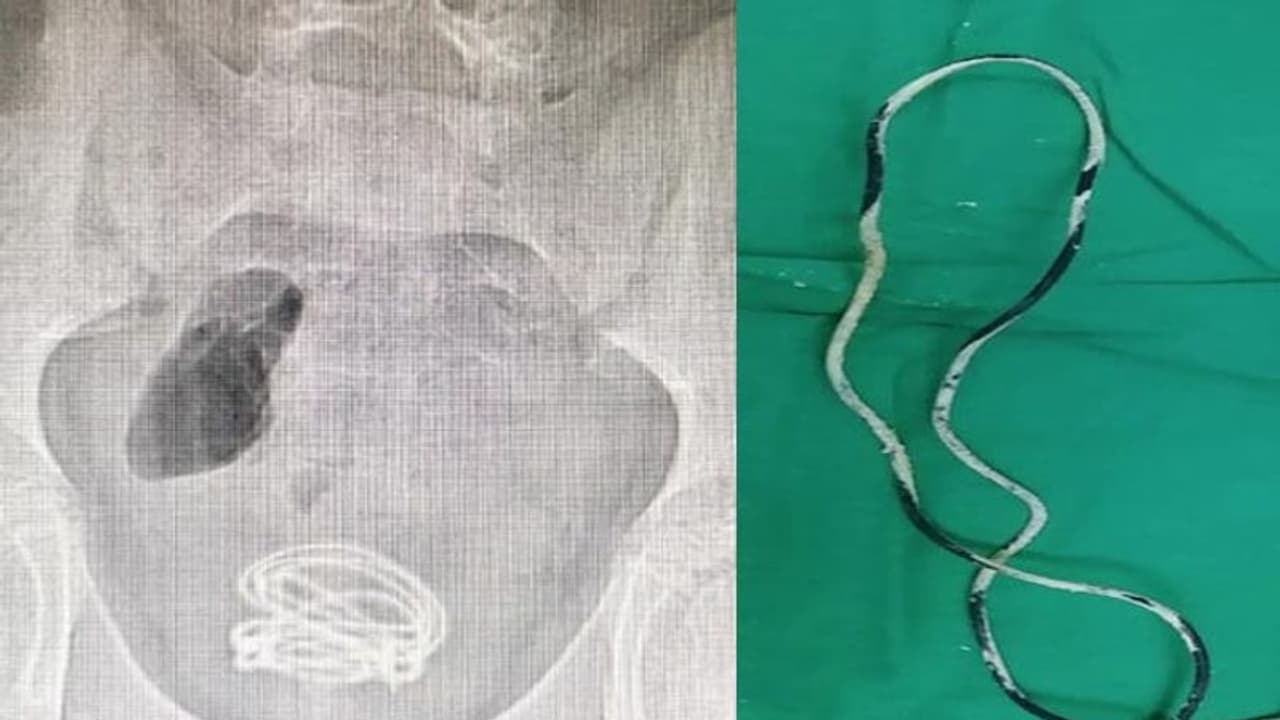 13 साल के बच्चे ने प्राइवेट पार्ट में घुसाया 2 फीट लंबा बिजली का तार, जानना था पेट में कहां से आती है पेशाब? 13 साल के बच्चे ने प्राइवेट पार्ट में घुसाया 2 फीट लंबा बिजली का तार, जानना था पेट में कहां से आती है पेशाब?