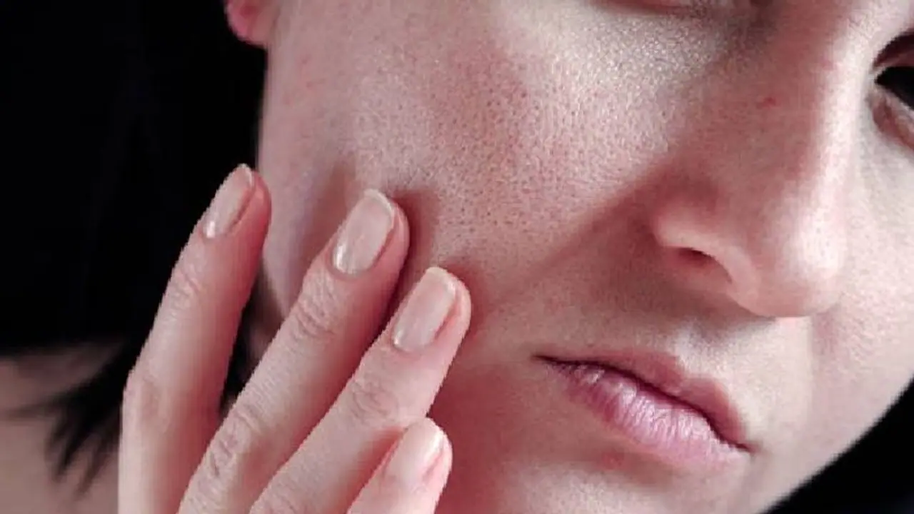 മുഖത്തെ കുഴികൾ മാറാന് പരീക്ഷിക്കാം ഈ നാല് വഴികള്... മുഖത്തെ കുഴികൾ മാറാന് പരീക്ഷിക്കാം ഈ നാല് വഴികള്...