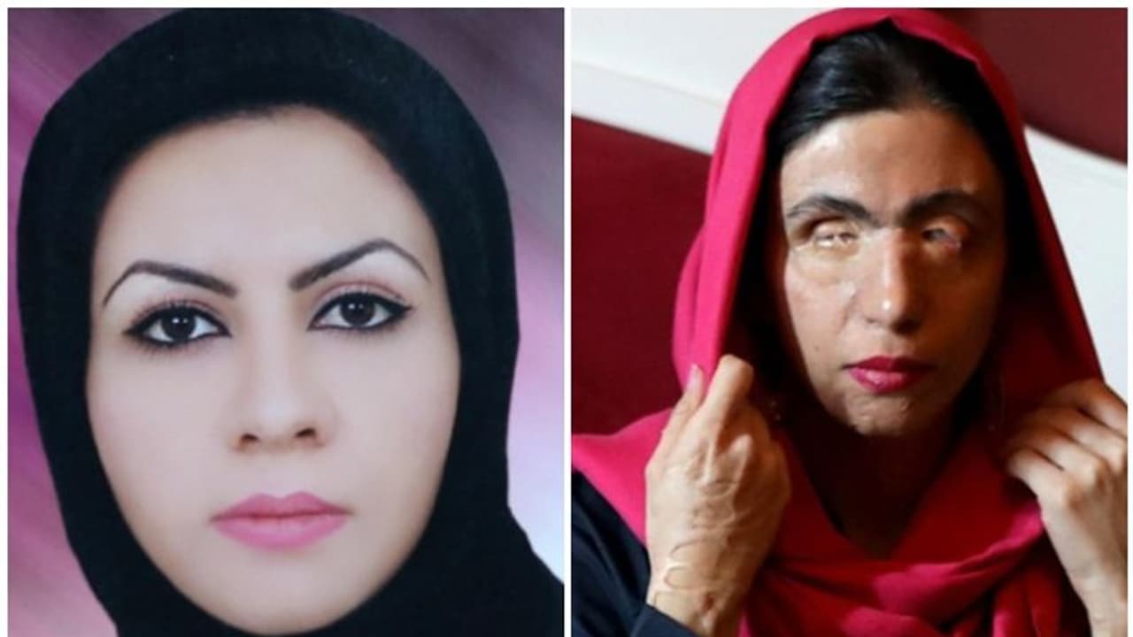 ആസിഡ് ആക്രമണത്തെ അതിജീവിച്ചു, വിധിയ്ക്ക് മുന്നിൽ തോൽക്കാൻ തയ്യാറായിരുന്നില്ല; മാസോമെയുടെ ജീവിതം ഇങ്ങനെ ആസിഡ് ആക്രമണത്തെ അതിജീവിച്ചു, വിധിയ്ക്ക് മുന്നിൽ തോൽക്കാൻ തയ്യാറായിരുന്നില്ല; മാസോമെയുടെ ജീവിതം ഇങ്ങനെ