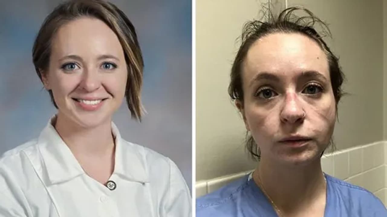 कोरोना मरीजों की देखभाल करते करते ऐसा हुआ नर्स का हाल, खुद फोटो शेयर कर बताई आपबीती कोरोना मरीजों की देखभाल करते करते ऐसा हुआ नर्स का हाल, खुद फोटो शेयर कर बताई आपबीती